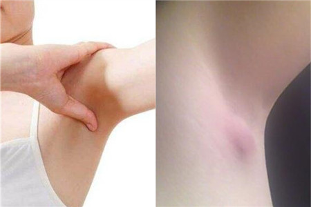 女性副乳疼图片
